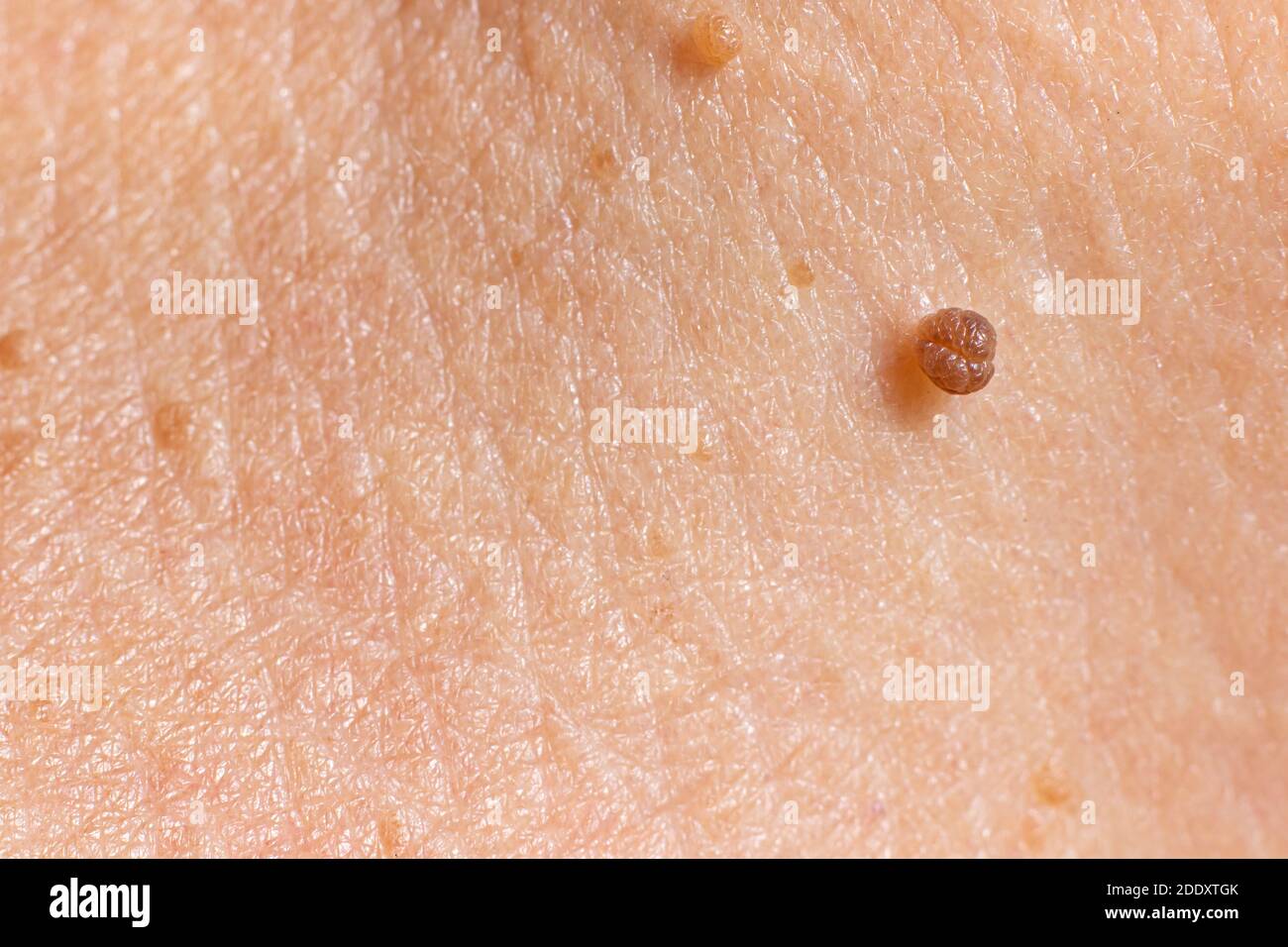 Papilloma sulla pelle umana - tumore benigno sotto forma di mole, nevo, tumore. Papillomatosi Foto Stock