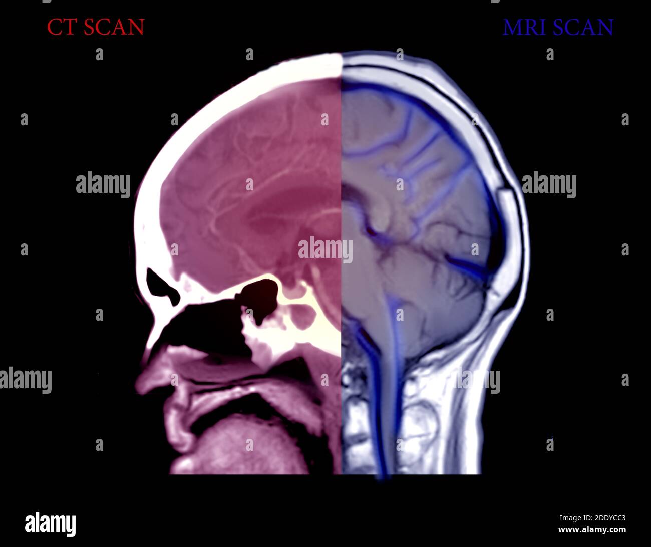 Confrontare la vista sagittale del cervello TC e del cervello RM . Concetto di background medico. Foto Stock