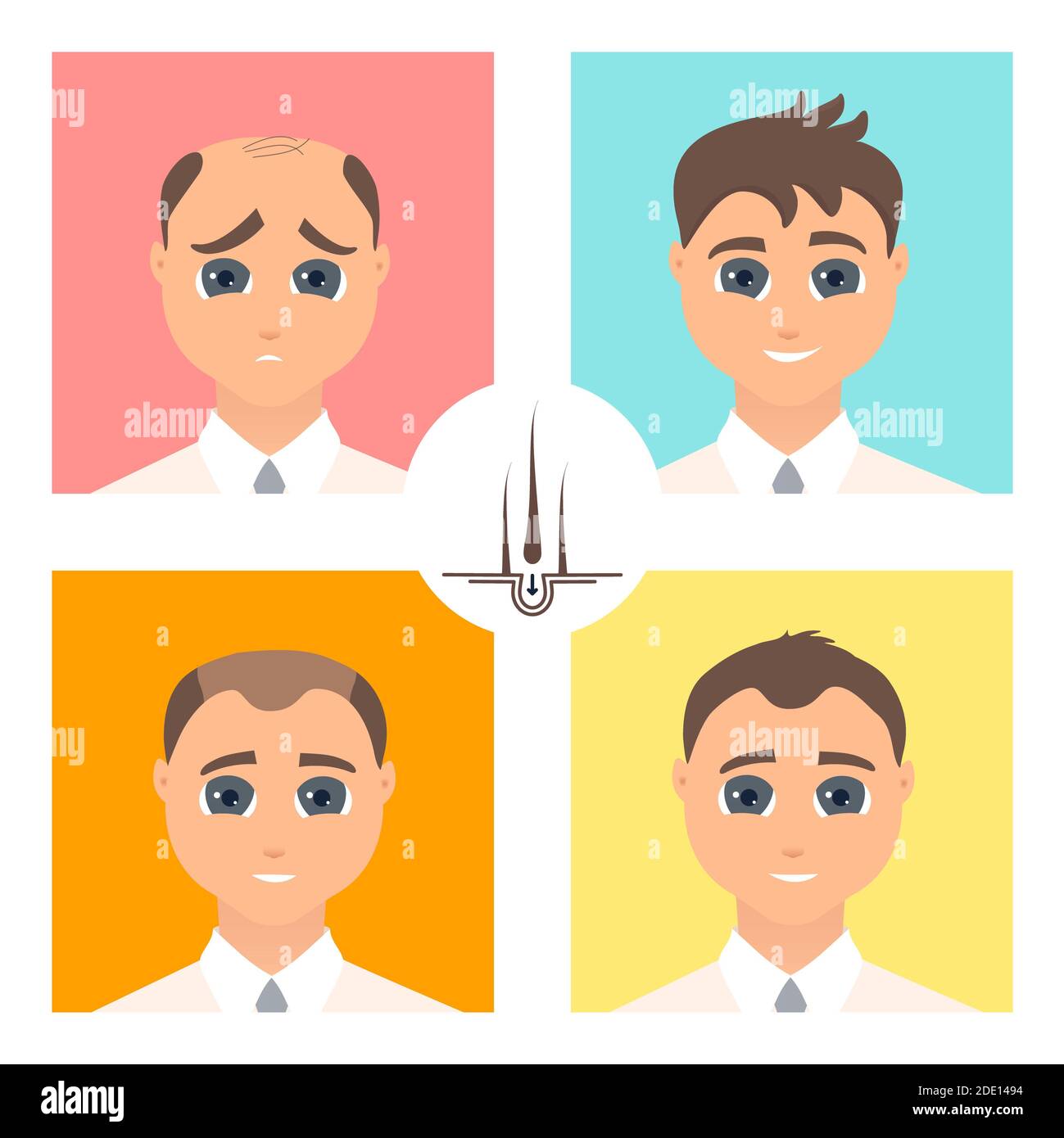 Trapianto di capelli, illustrazione Foto Stock