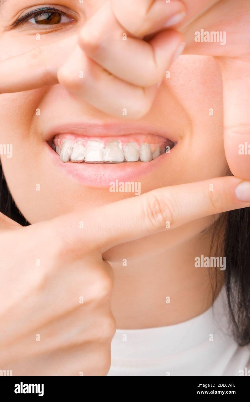 Donna sorridente in allineatori chiari e invisibili che fanno una cornice a mani. Foto Stock