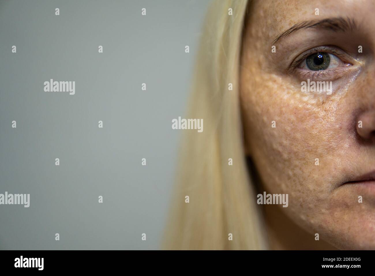 Viso della donna dopo iniezioni di mesoterapia. Iniezioni di bellezza. Alta qualità Foto Stock