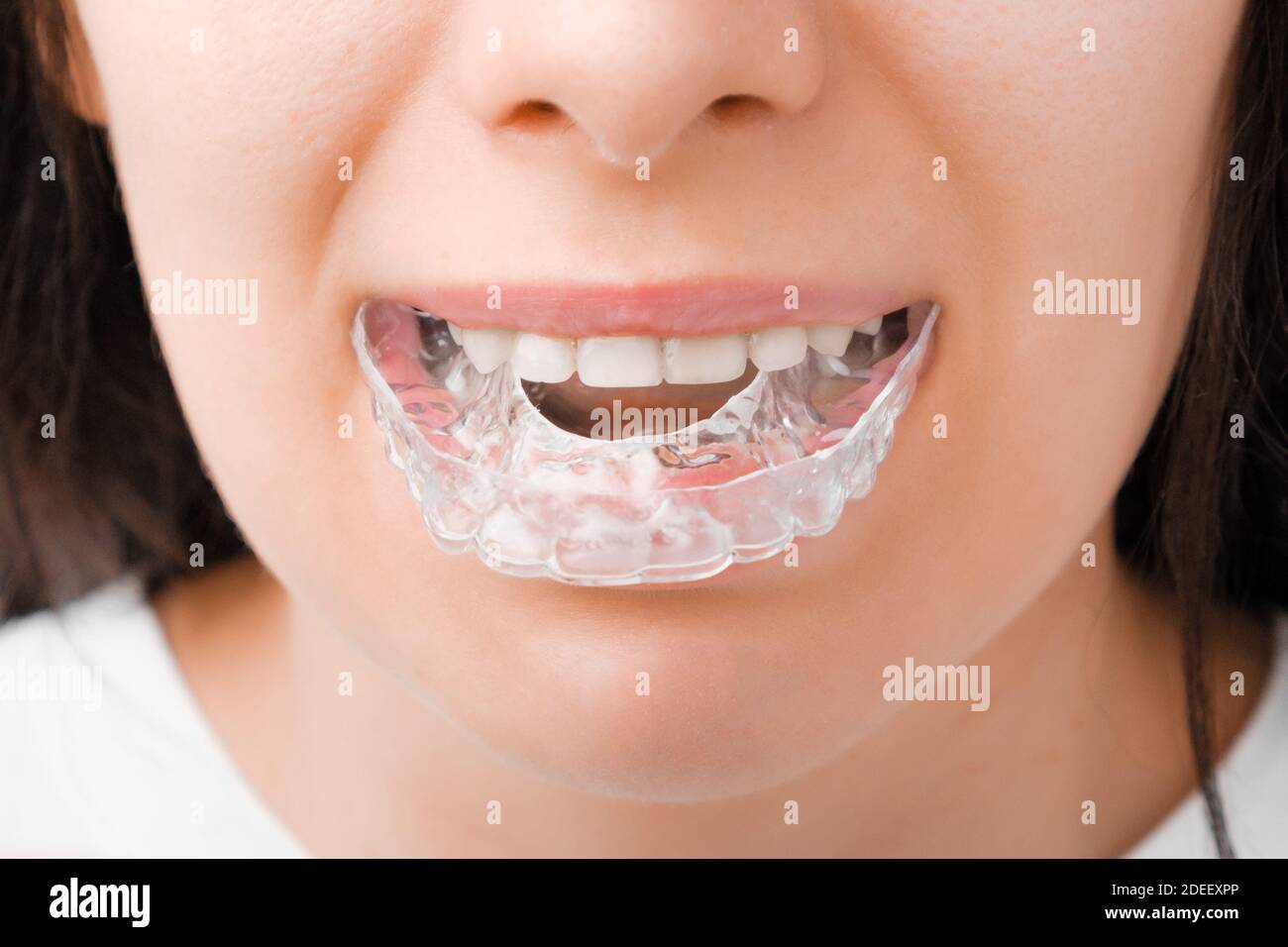 Donna sorridente con denti perfetti e sani con bretelle rimovibili o aligner per lisciare e sbiancare i denti. Trattamento ortodontico per Foto Stock