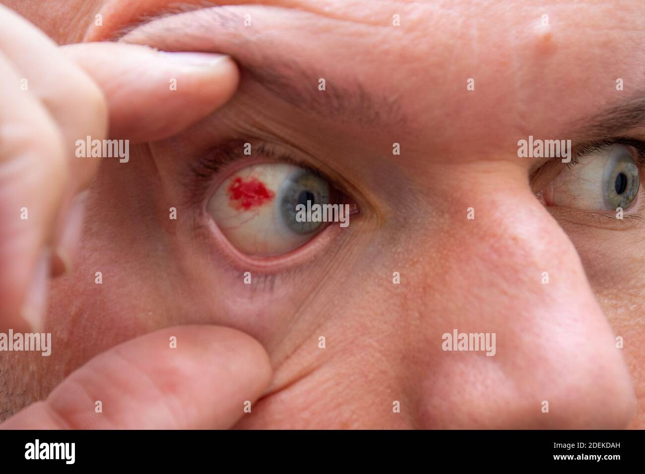 Un occhio da vicino ampio aperto di un'emorragia subcongiuntivale macchia  di sangue rosso in un occhio di uomo caucasico vicino iris per concetti  medici ed educativi Foto stock - Alamy