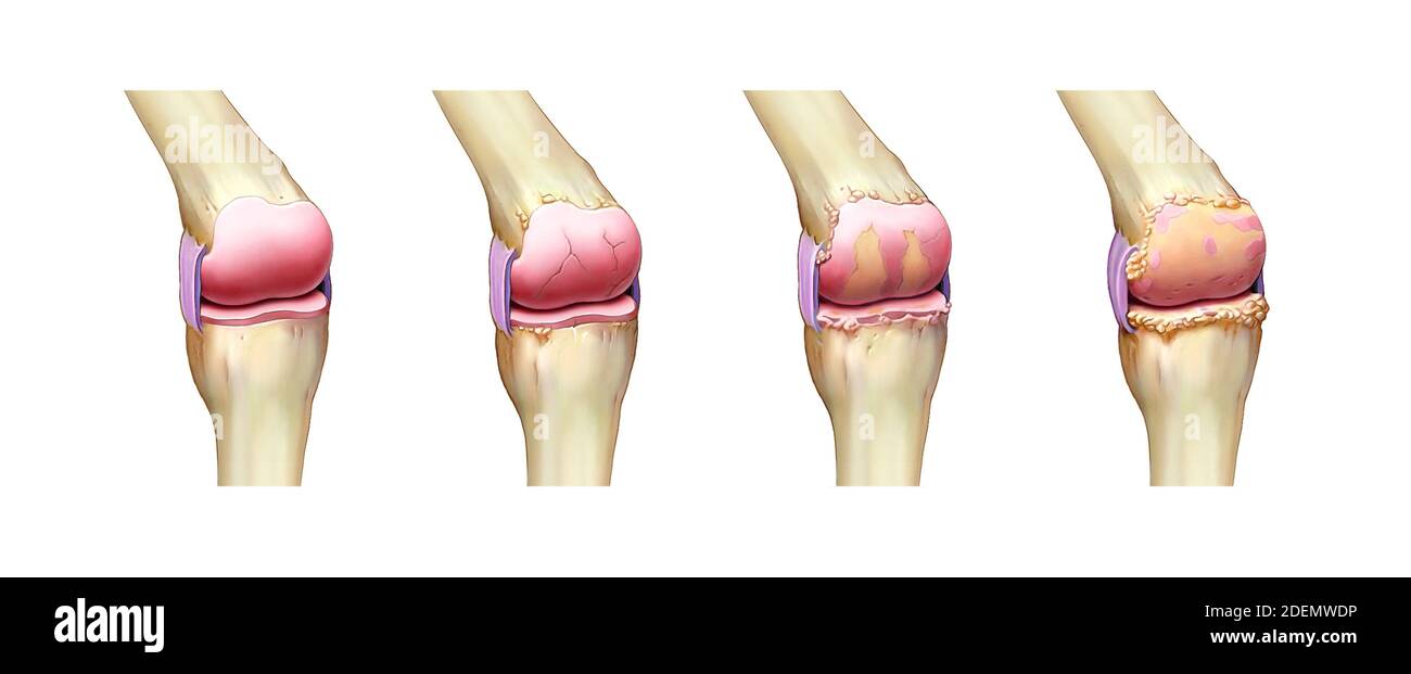 anatomia dell'artrite del ginocchio Foto Stock