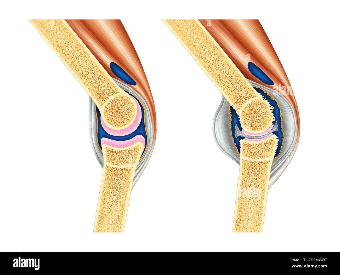 anatomia dell'artrite del ginocchio Foto Stock