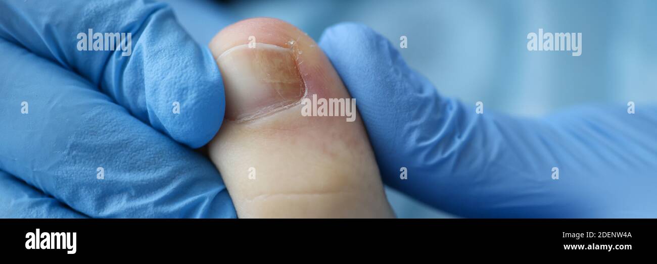 Le mani del medico in guanti di gomma toccano il toenail ferito in clinica primo piano Foto Stock