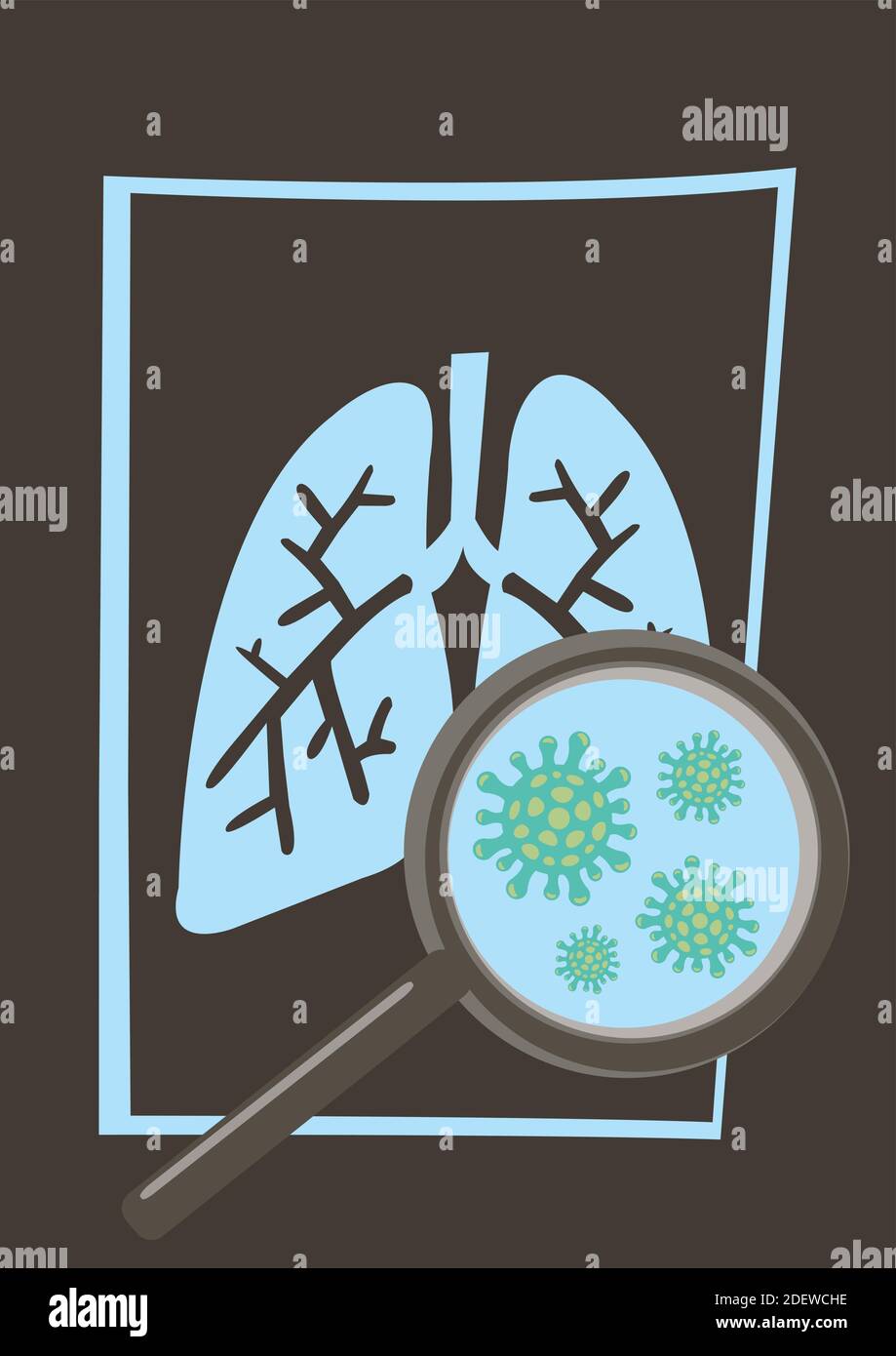 Malattia del coronavirus COVID-19 infezione medica nei polmoni di raggi X. Illustrazione vettoriale Illustrazione Vettoriale