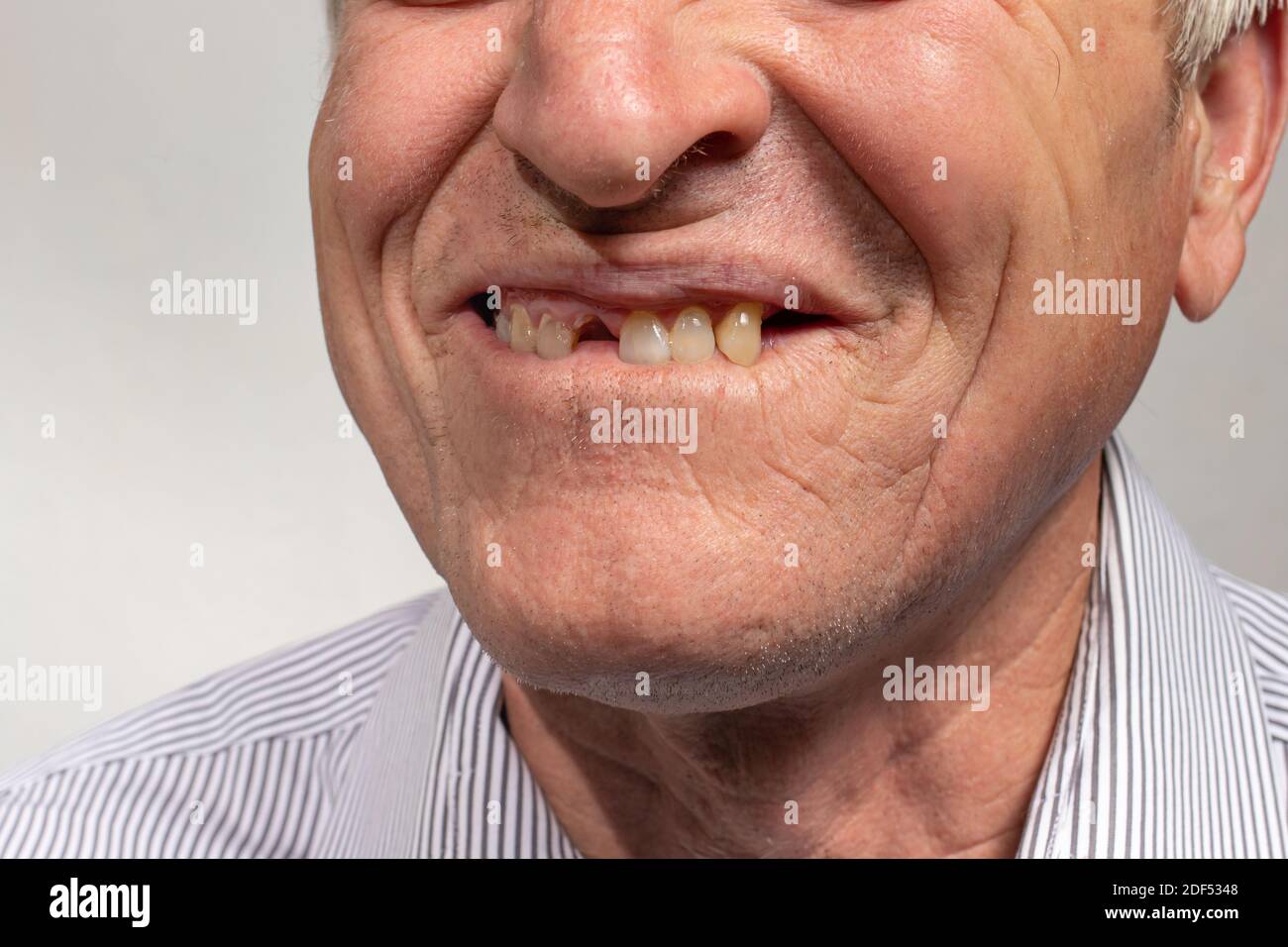 Il sorriso senza denti di un vecchio europeo su sfondo grigio. Odontoiatria per pensionati, felice vecchiaia Foto Stock