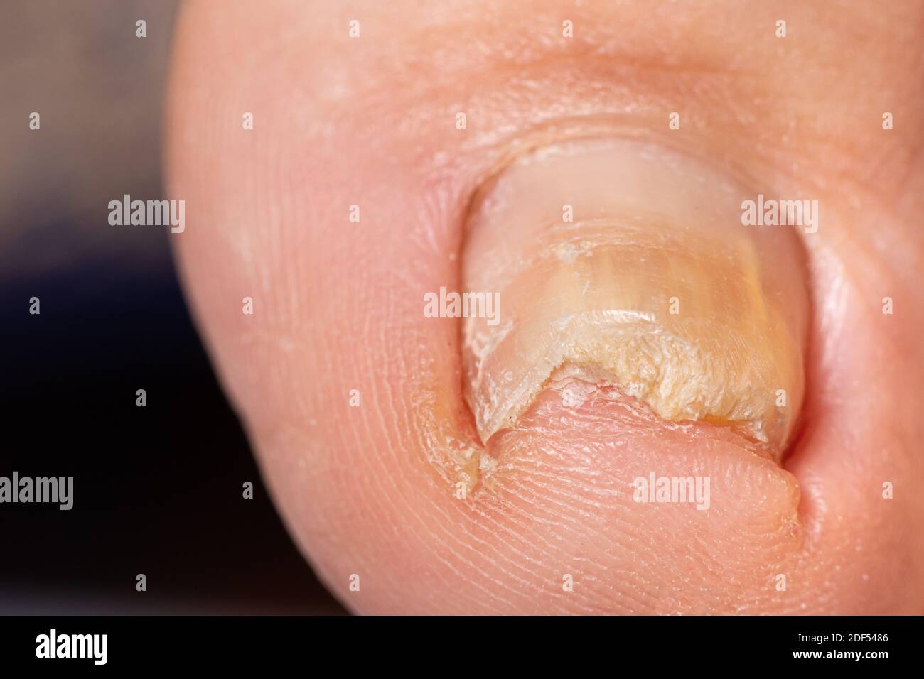 Fungo di unghie sul piede grande - dermatomicosi e onicosi, infezione fungina macro foto. Foto Stock