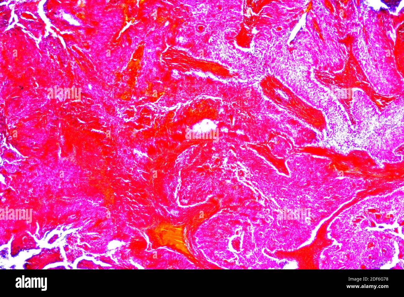 Cervice uterina immagini e fotografie stock ad alta risoluzione - Alamy
