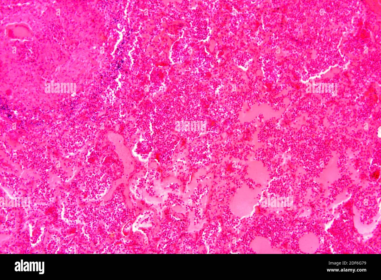 Sezione polmonare della tubercolosi umana. Microscopio ottico X100. Foto Stock