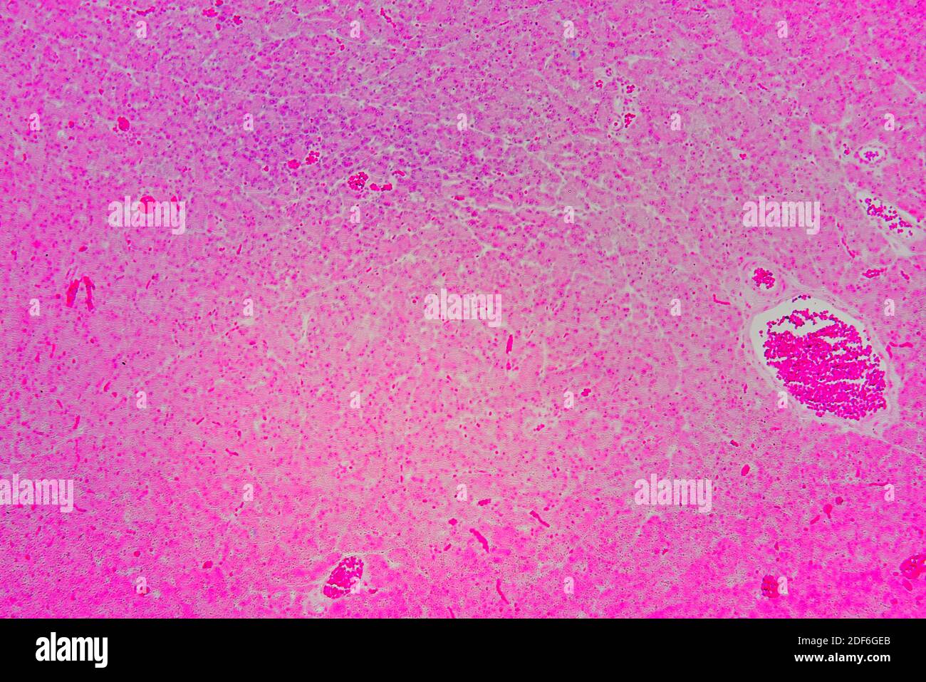 Pancreas umano con diabete mellito di tipo 1 che mostra acina, e isolette di Langerhans. Microscopio ottico X100. Foto Stock