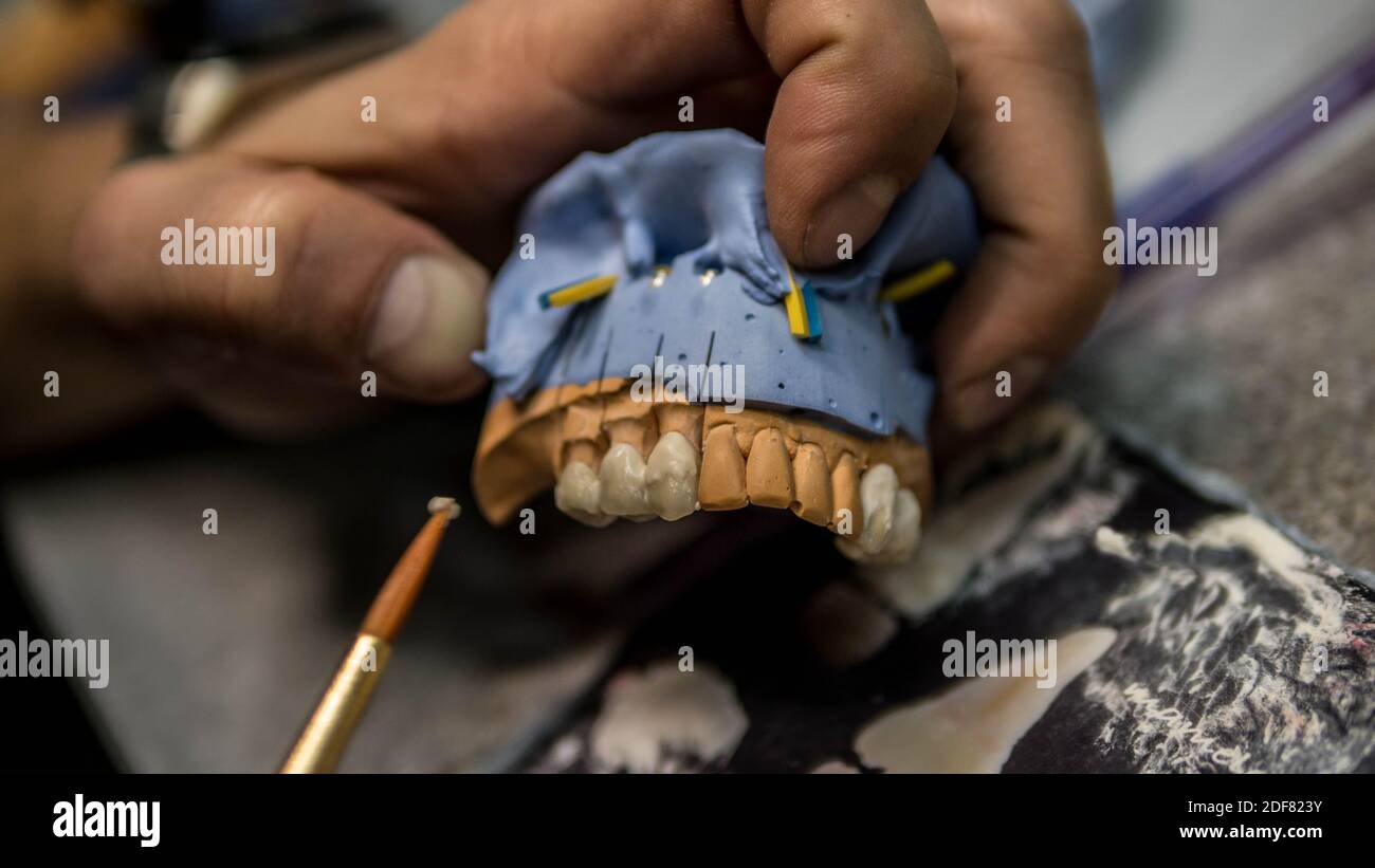 Un chirurgo dentale scolpisce le protesi, un modello di gesso, un tecnico dentale fa Una protesi.modello di denti nella mano del dentista Foto Stock