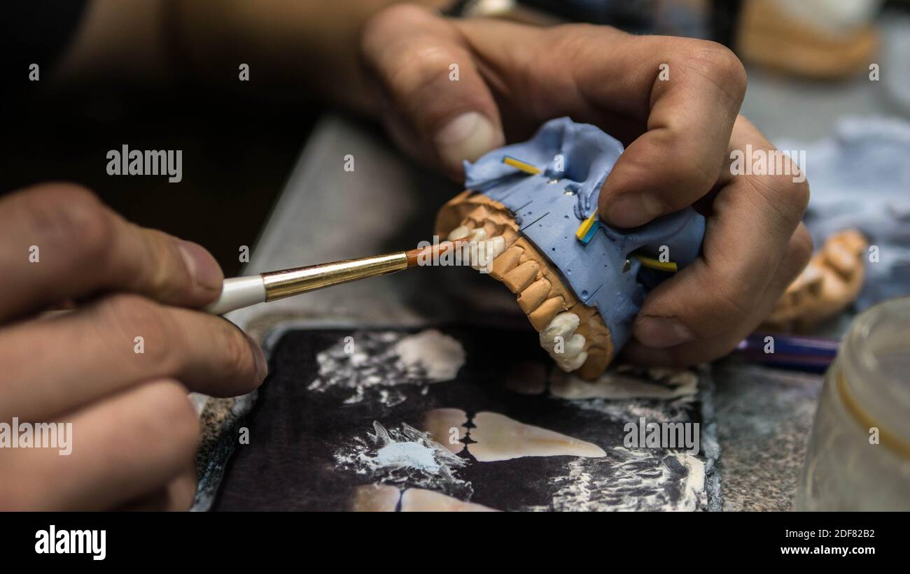 Il chirurgo dentale sculpta le dentiere, dimostrando un primo piano della corona ceramica su un Modello di intonaco di denti nel dentista hand.The lavoro di un tecnico dentale Foto Stock