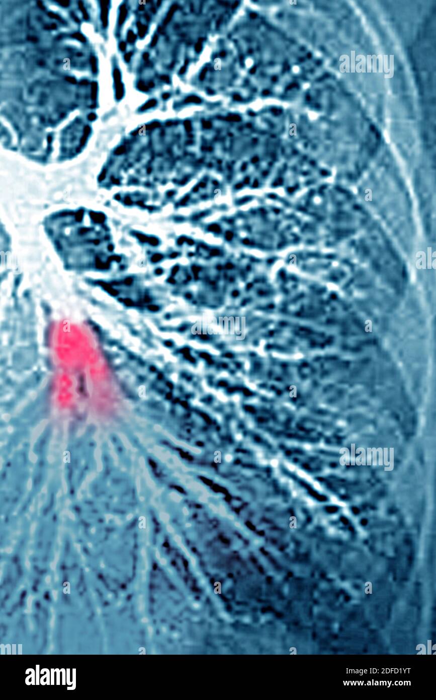 Embolia polmonare nel lobo inferiore sinistro (arteria polmonare bloccata da un coagulo di sangue). Angiografia toracica. Foto Stock