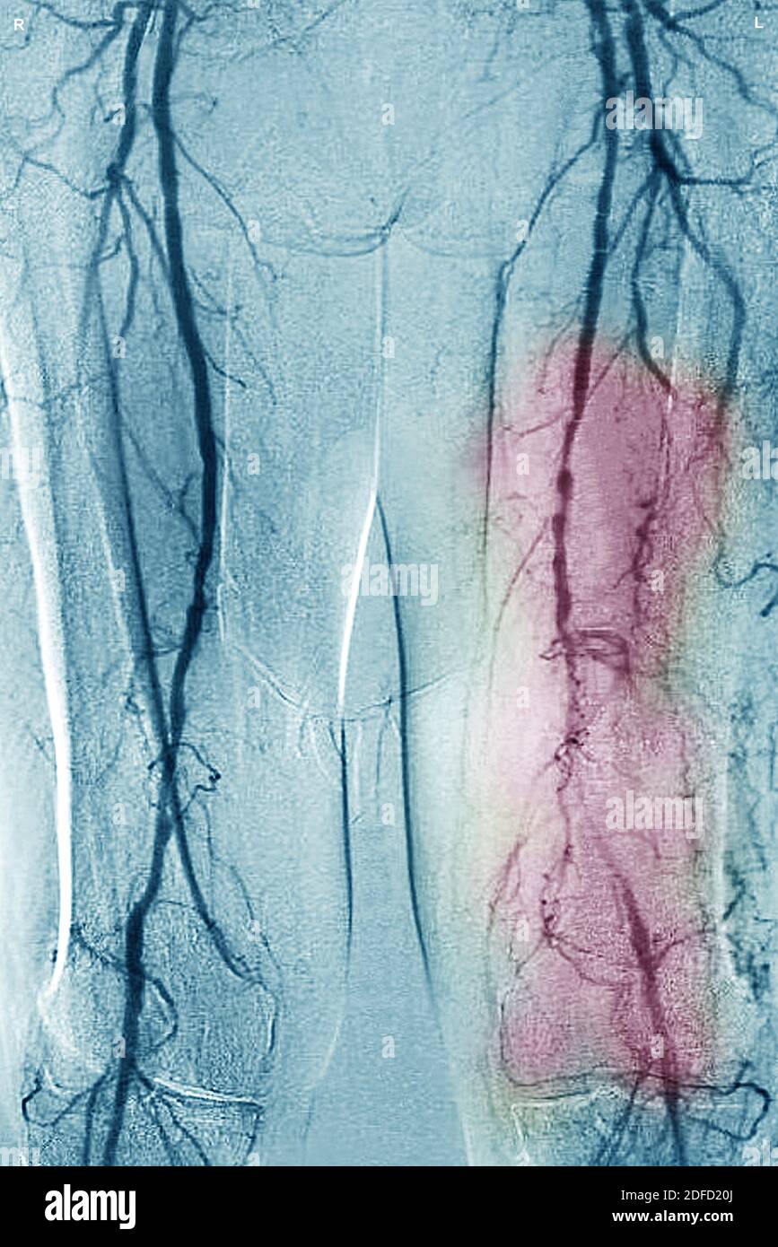 Obliterazione della malattia arteriosa degli arti inferiori Foto Stock