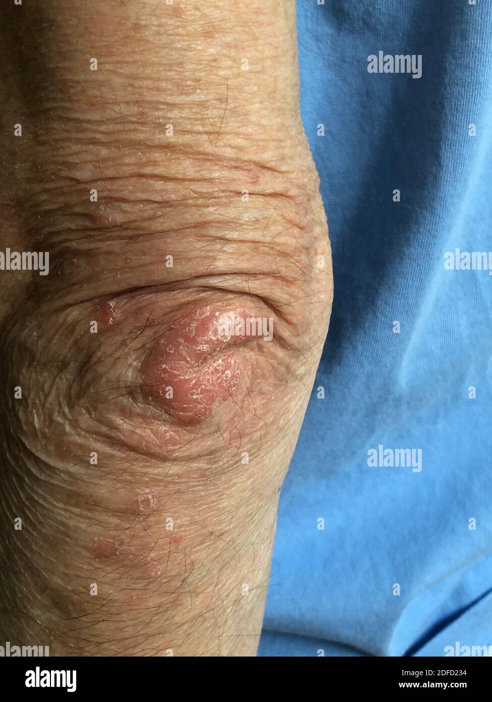 Psoriasi Foto Stock