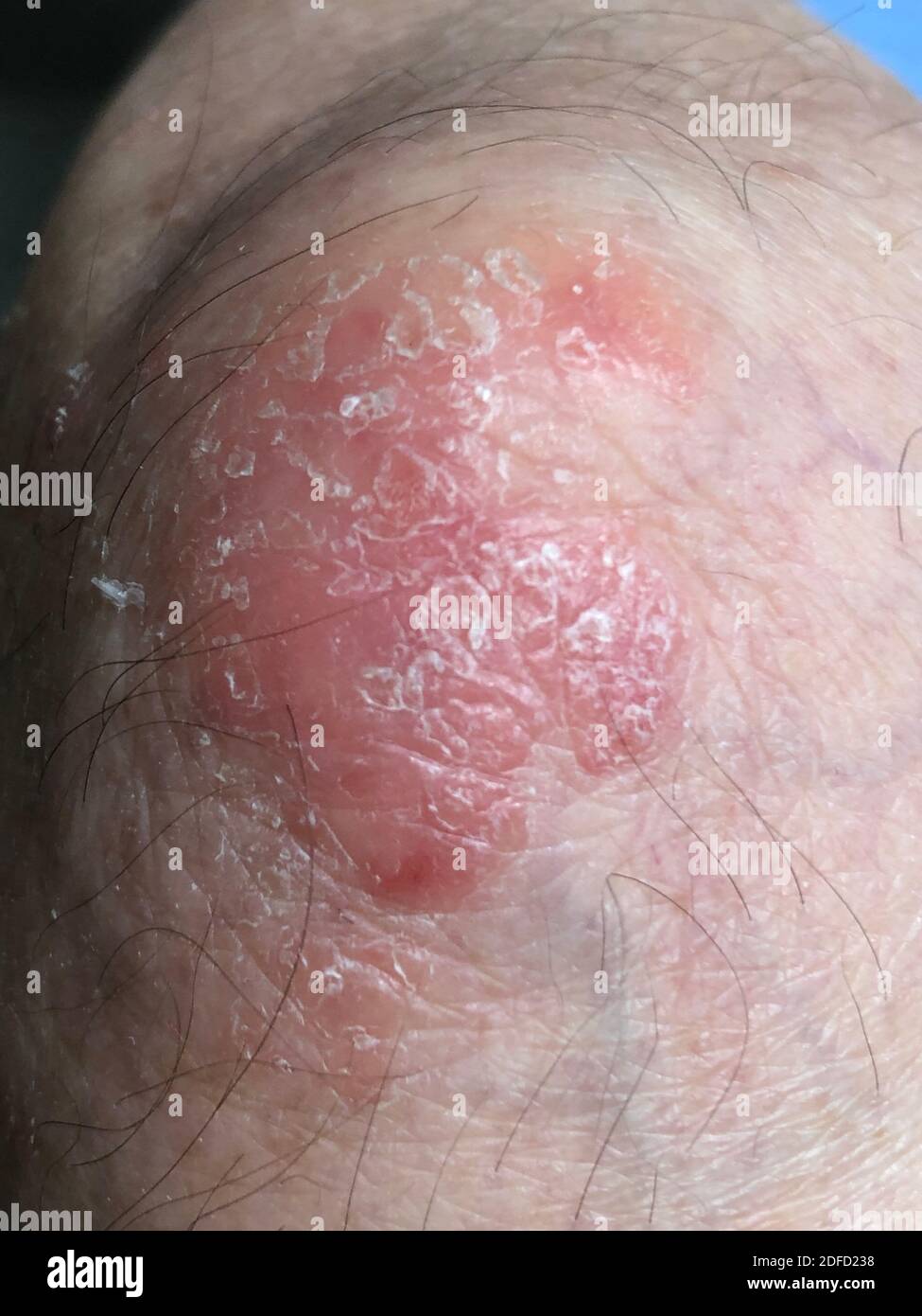 Psoriasi Foto Stock
