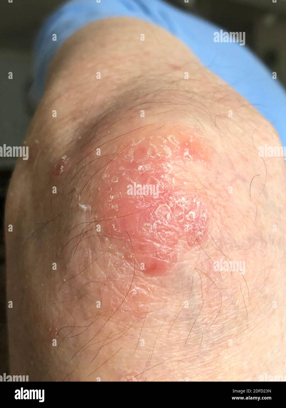 Psoriasi Foto Stock