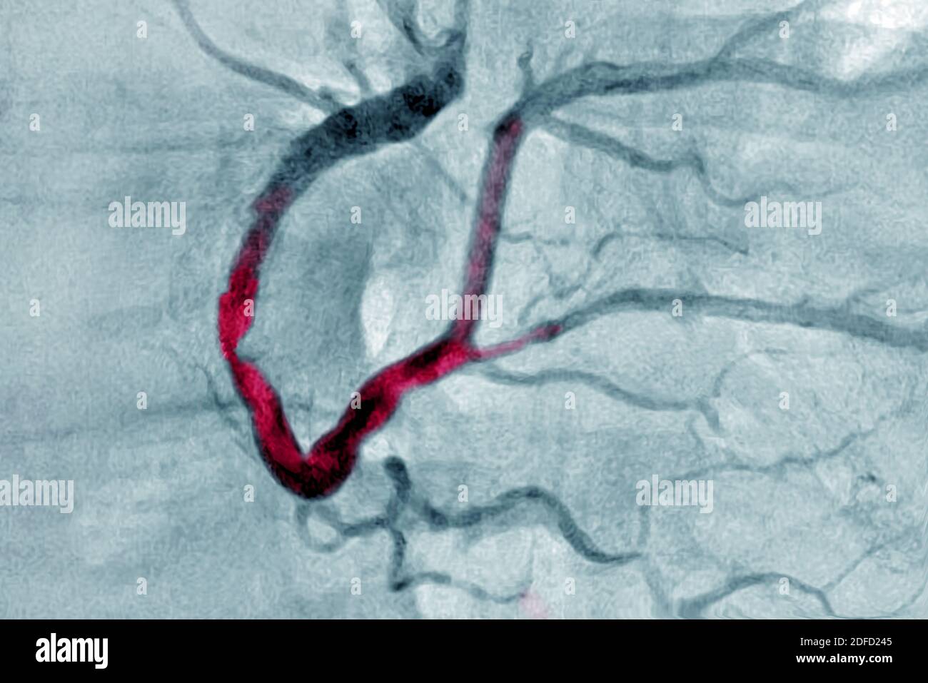 Infarto miocardico con un trombo significativo nella coronaria destra e si estende nel ventricolo posteriore sinistro e nel intervent posteriore Foto Stock