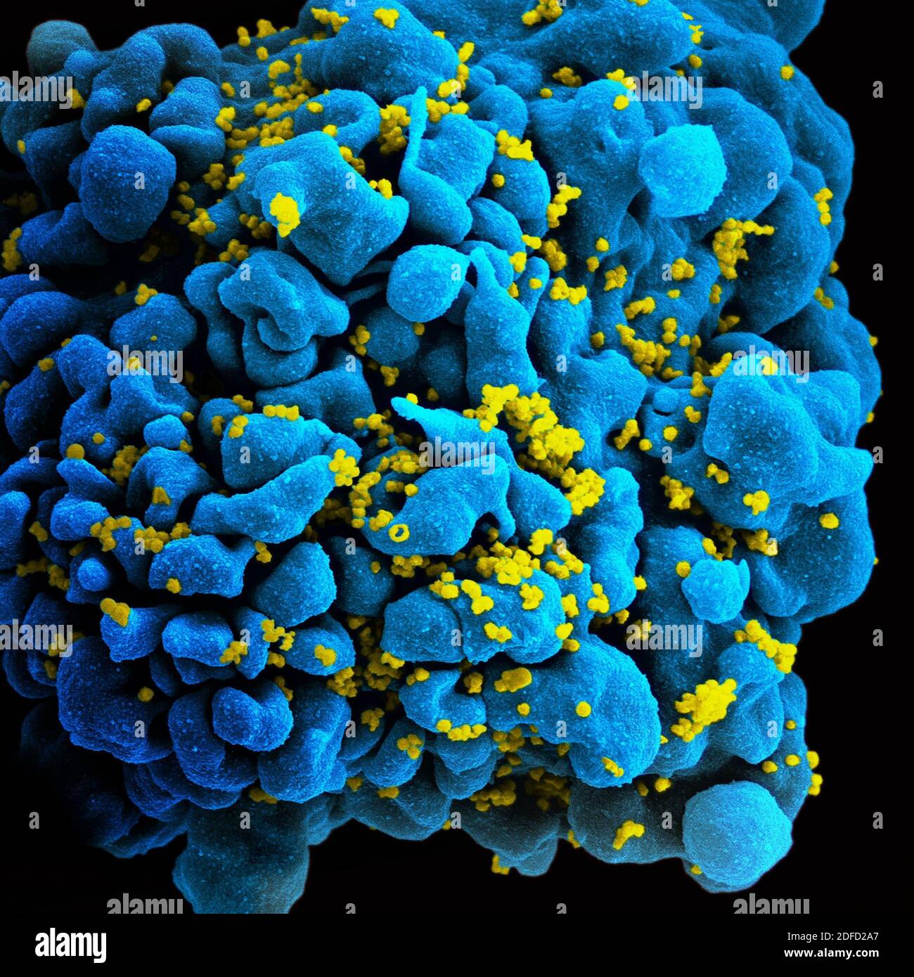 Cellula t infettata da HIV Foto Stock