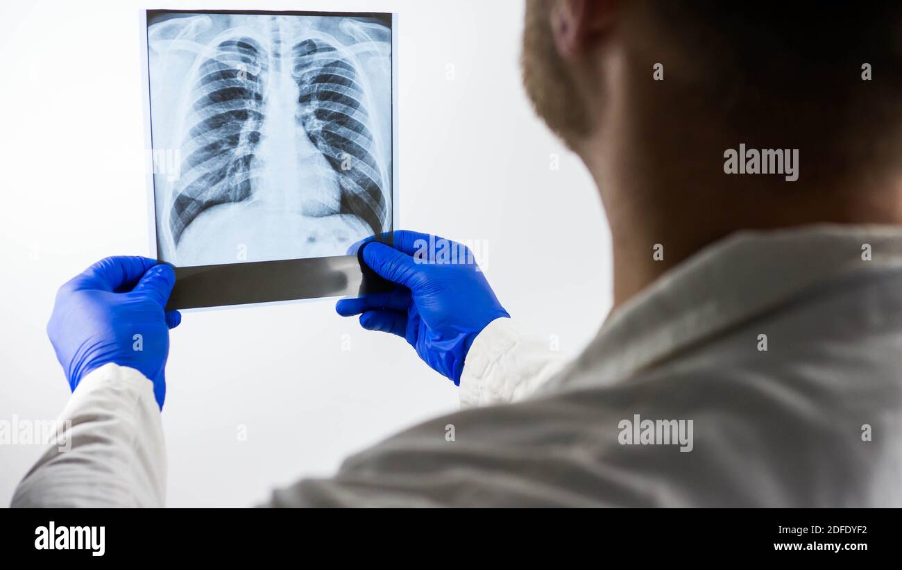 Raggi X dei polmoni umani su sfondo bianco nelle mani di un medico, immagine di polmonite polmonare, edema del tratto polmonare umano, primo piano. Foto Stock