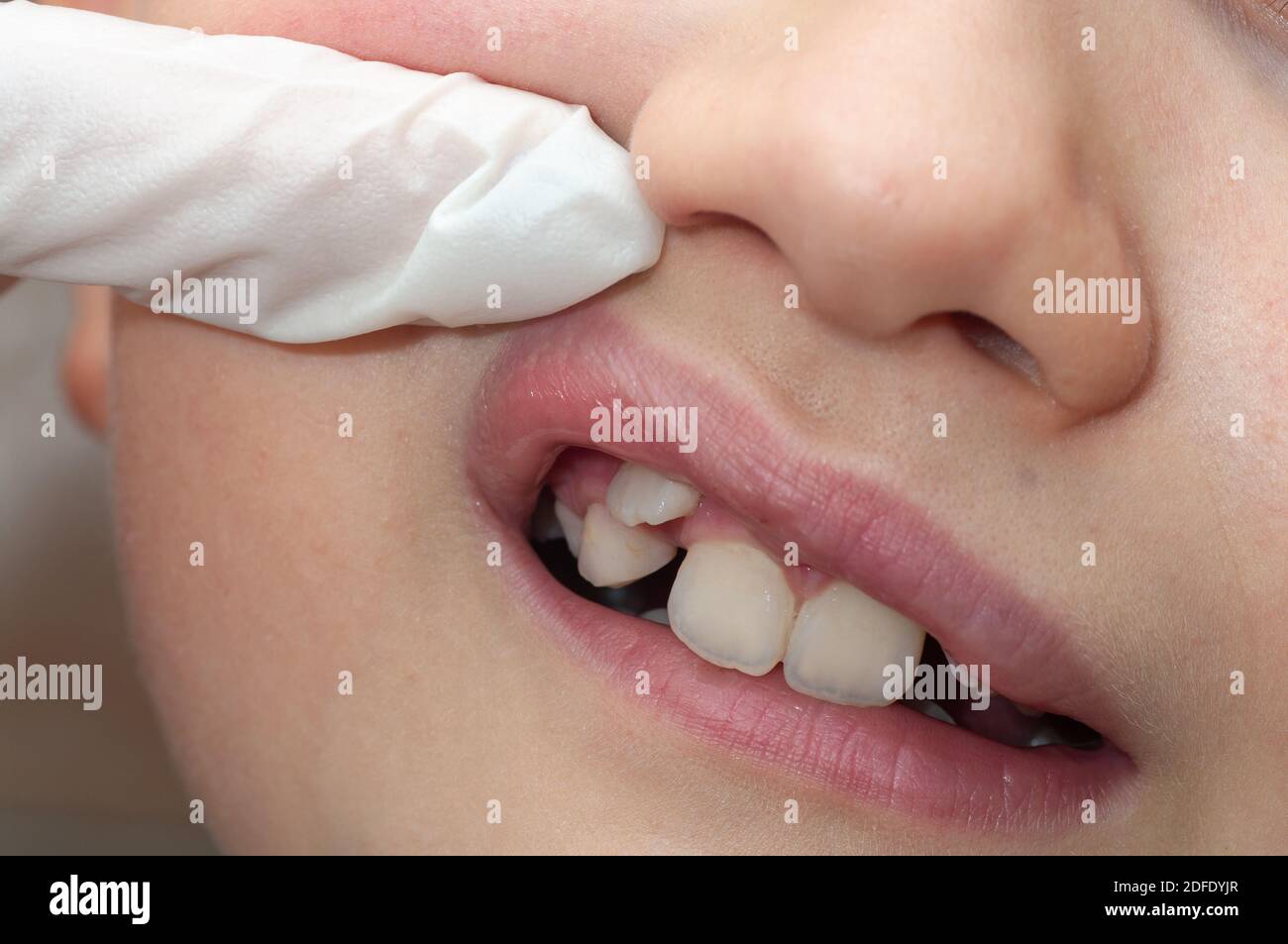 Ortodontista che esamina la bocca del ragazzo. Il dente sta crescendo nel posto sbagliato Foto Stock