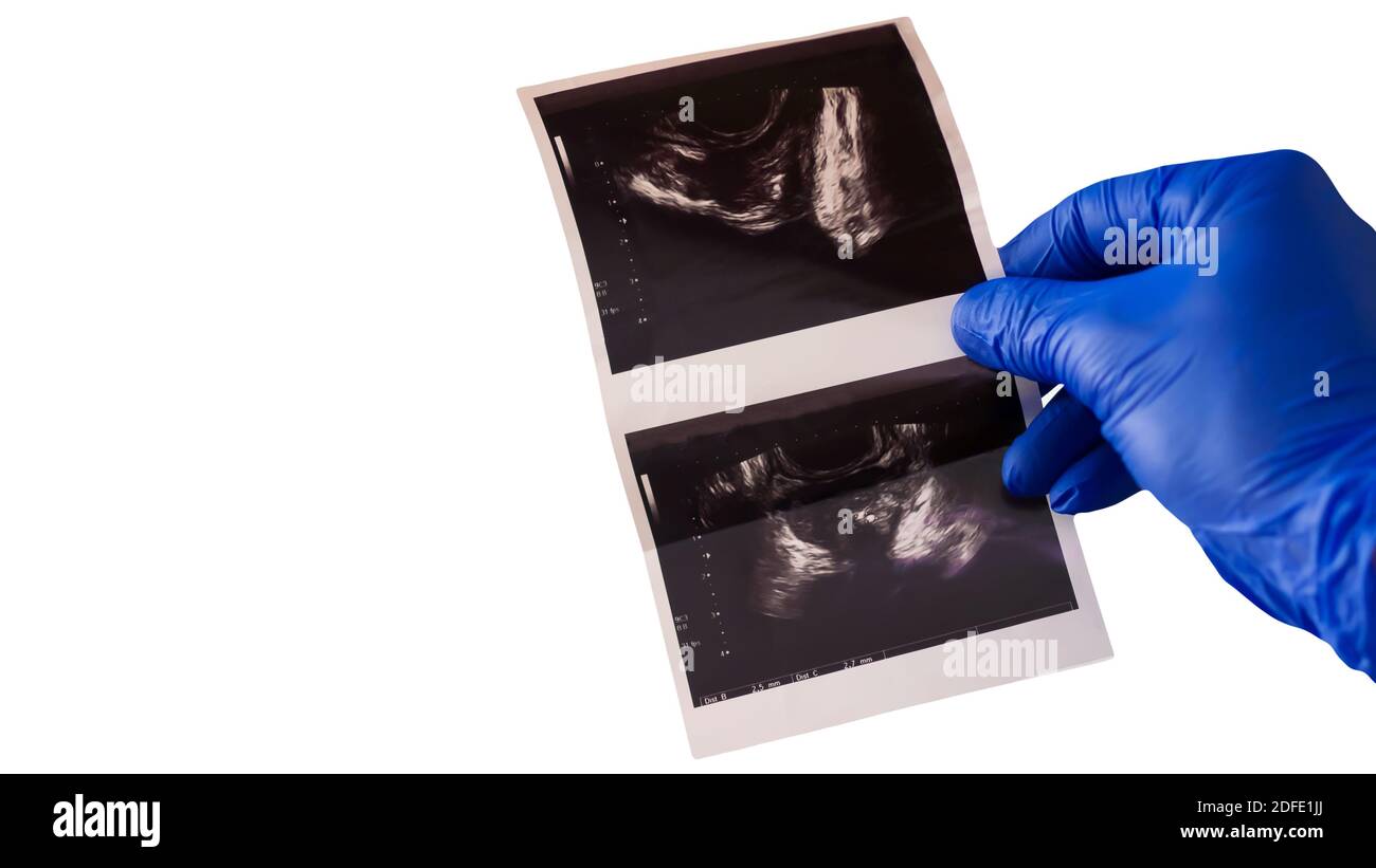 Ecografia transrettale della prostata. Il medico esamina il paziente mediante raggi X. Foto Stock