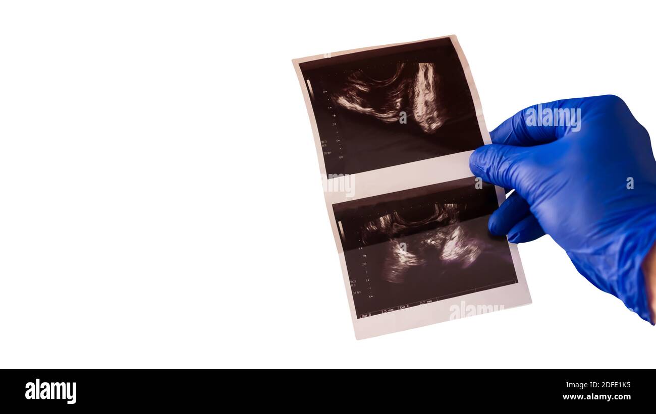 Il medico dimostra una radiografia della ghiandola prostatica maschile, per diagnosticare l'immagine radiografica della prostata, su uno sfondo bianco. Foto Stock