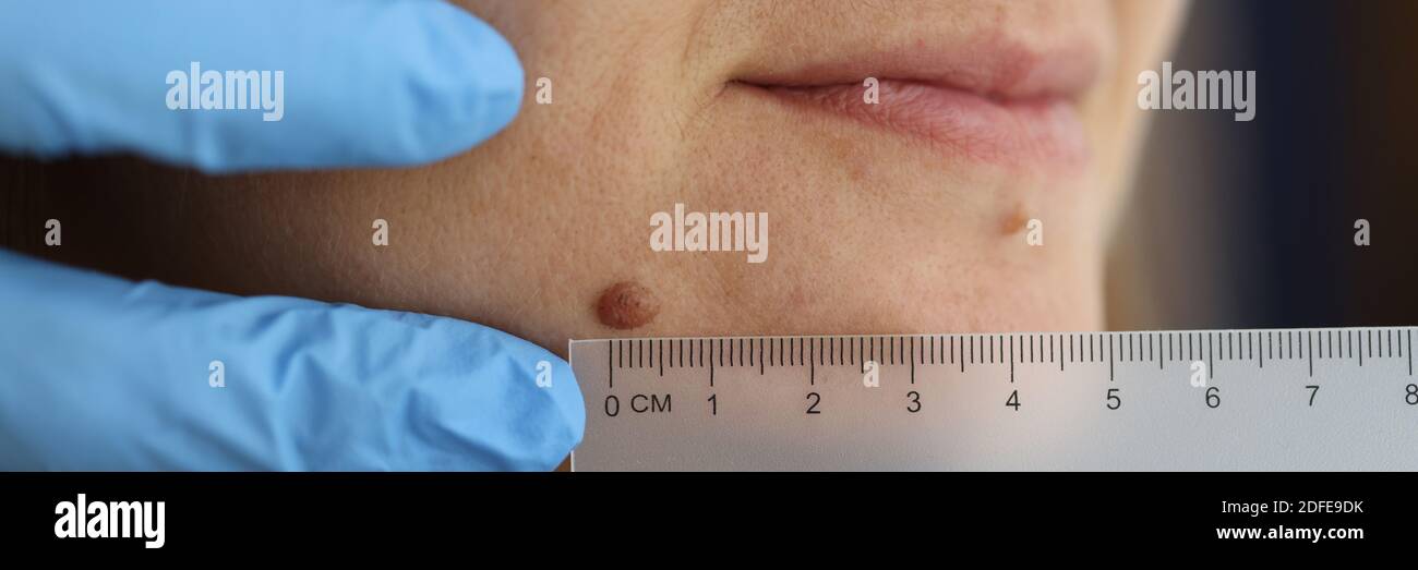 Verruca scura sul viso della donna con il righello Foto Stock