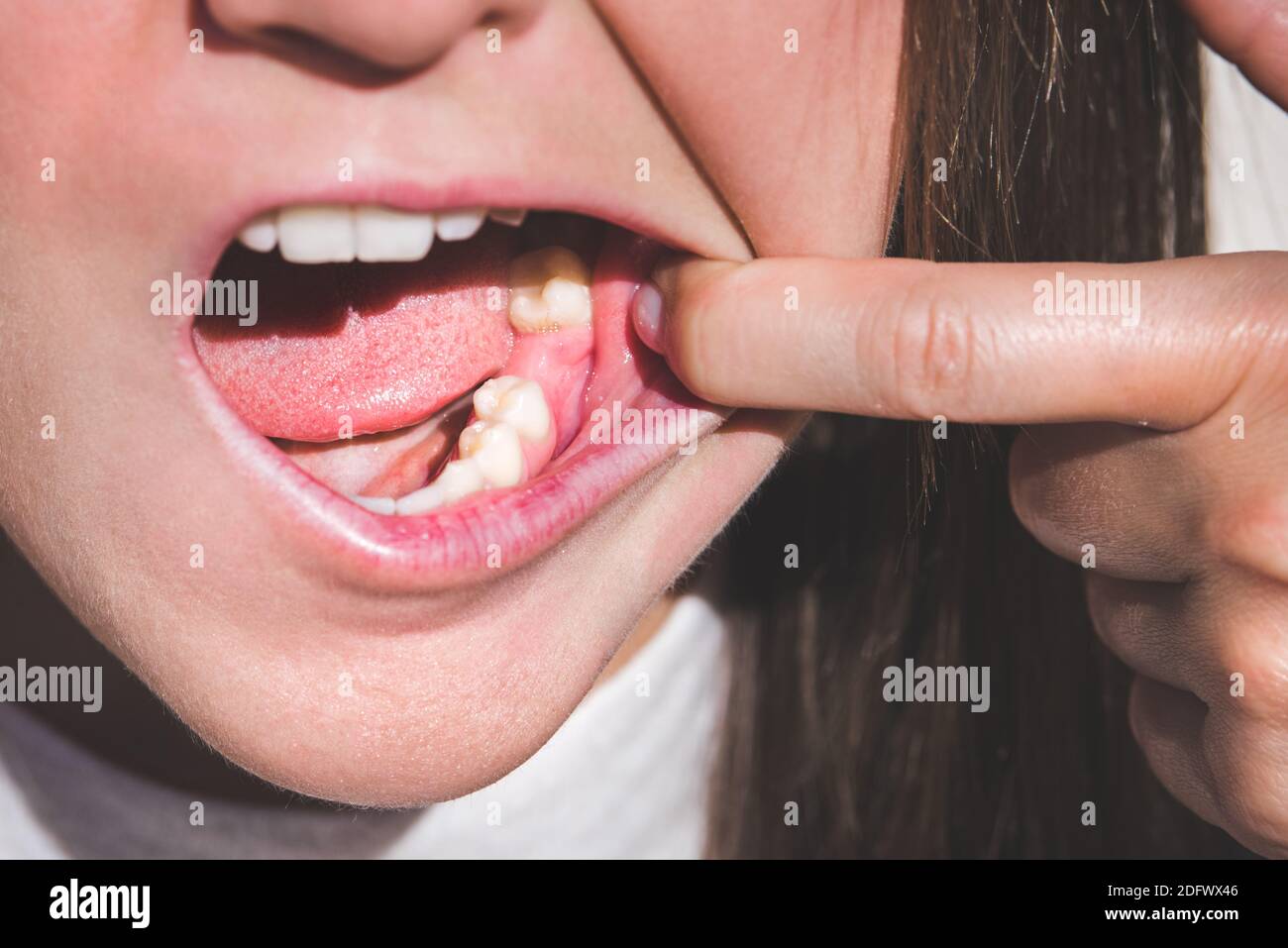 Giovane donna che mostra bocca senza dente sulla mascella inferiore. Dente mancante. In attesa di un impianto dopo l'estrazione del dente Foto Stock