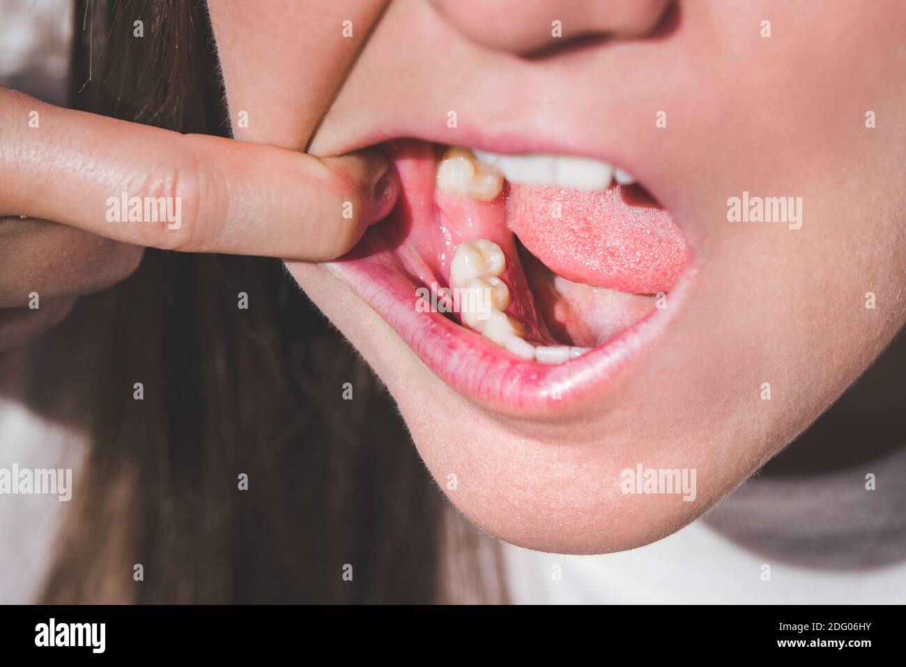 Giovane donna con bocca aperta senza dente sulla mascella inferiore. Dente mancante. In attesa di un impianto dopo l'estrazione del dente Foto Stock