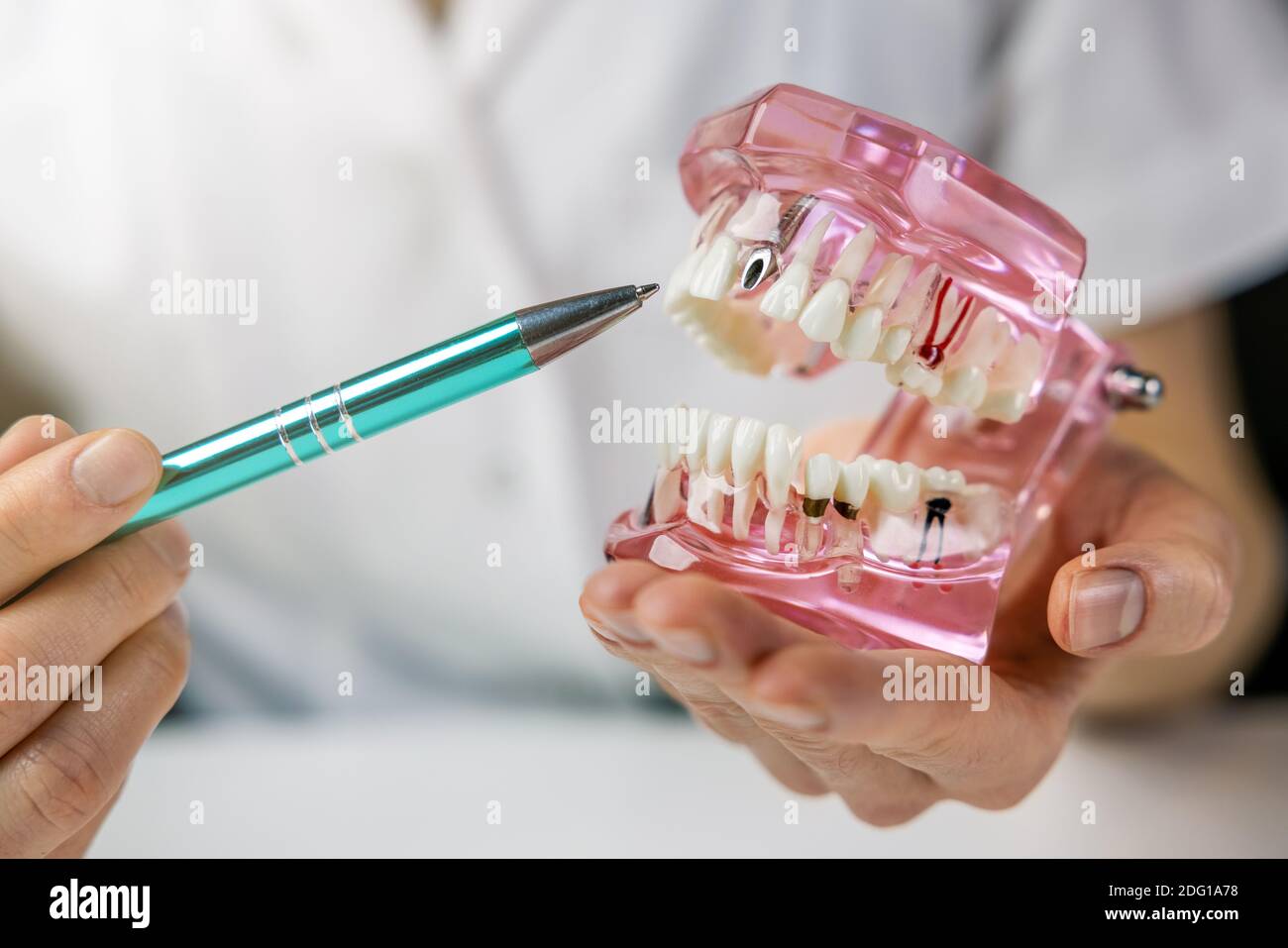 implantologo dentista che mostra la tecnologia dell'impianto dentale sulla mascella del dente umano modello Foto Stock