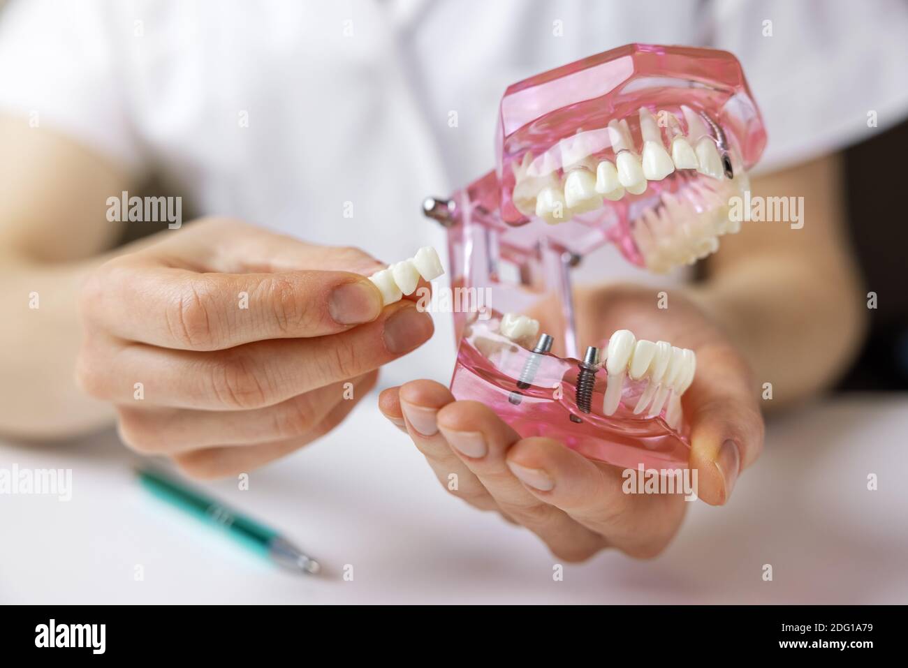 implantologo dentista che mostra la tecnologia di impianto di ponte dentale sul dente umano modello ganascia Foto Stock