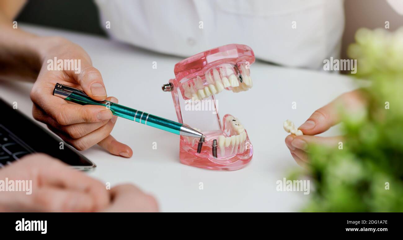 implantologo dentista che mostra al paziente la tecnologia dell'impianto dentale sul modello della mascella dentaria. visita in studio clinico Foto Stock