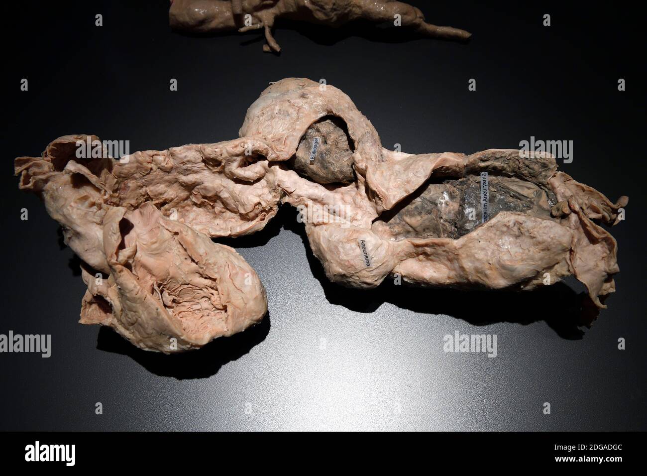 Präparat, Plastinat, Anourysma einer Aorta, Menschen Museum di Berlino, Deutschland Foto Stock