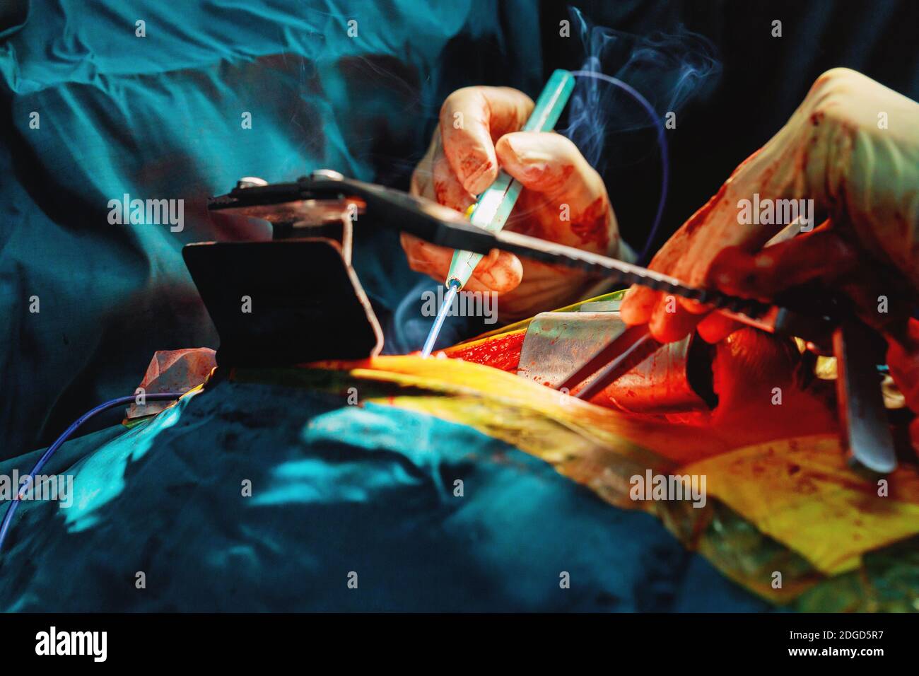 La chirurgia sala operatoria con elettrocauterizzazione per equipaggiamento cardiovascolare chirurgia di emergenza centro. Foto Stock