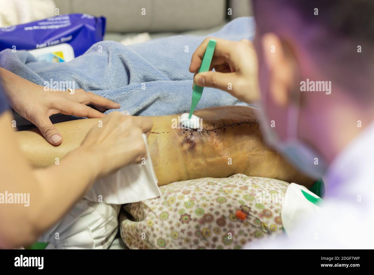 Medico che pulisce il ginocchio del paziente dopo un intervento chirurgico con alcool. Foto Stock