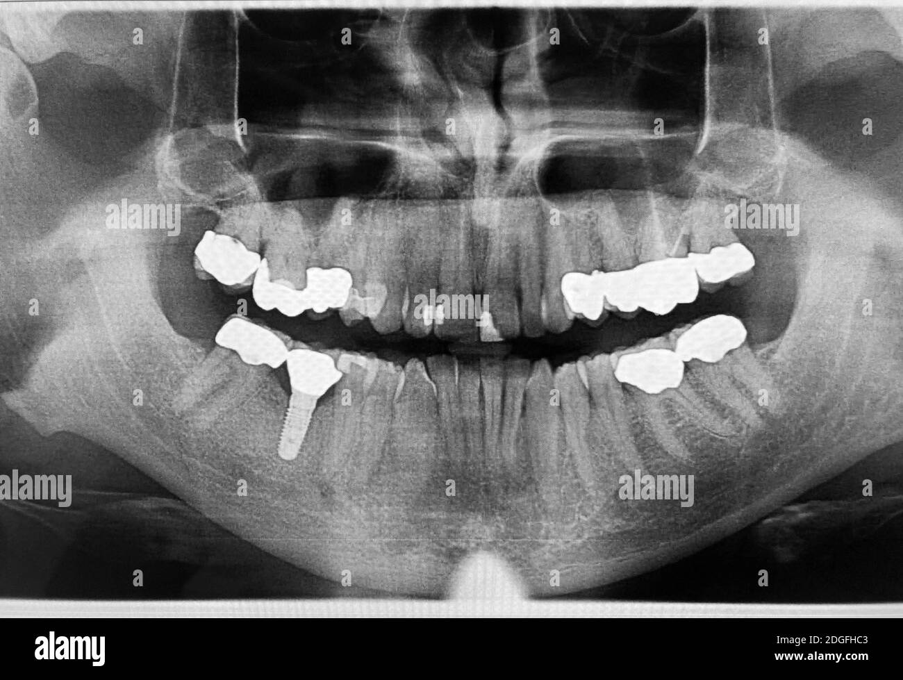 Immagine a raggi X dei denti Foto Stock