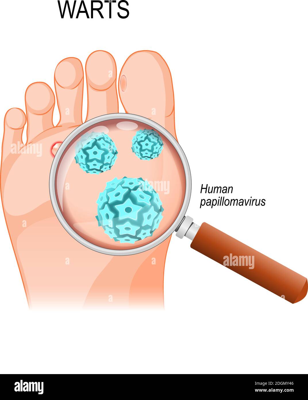 Le verruche del piede sono causate da infezione con un tipo di papillomavirus umano. Primo piano di HPV Illustrazione Vettoriale