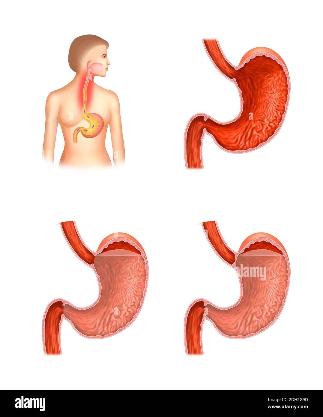 Illustrazione anatomica della malattia da reflusso esofageo e dello stomaco Foto Stock