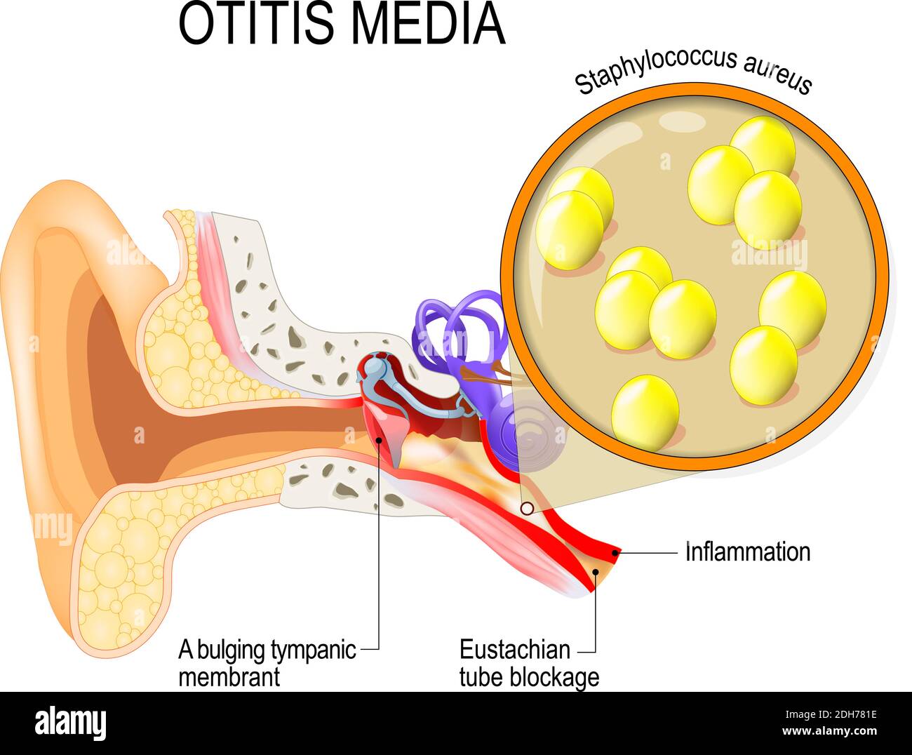 Otite media è infiammazione dell'orecchio medio. Infezioni batteriche malattia. Primo piano di Staphylococcus aureus. Anatomia umana. Illustrazione Illustrazione Vettoriale