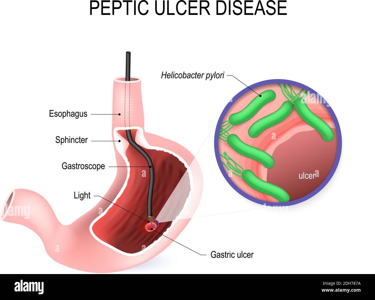 Ulcera peptica (PUD), ulcera gastrica o ulcera gastrica. Stomaco umano con endoscopio e vista ravvicinata del batterio Helicobacter pylori Illustrazione Vettoriale