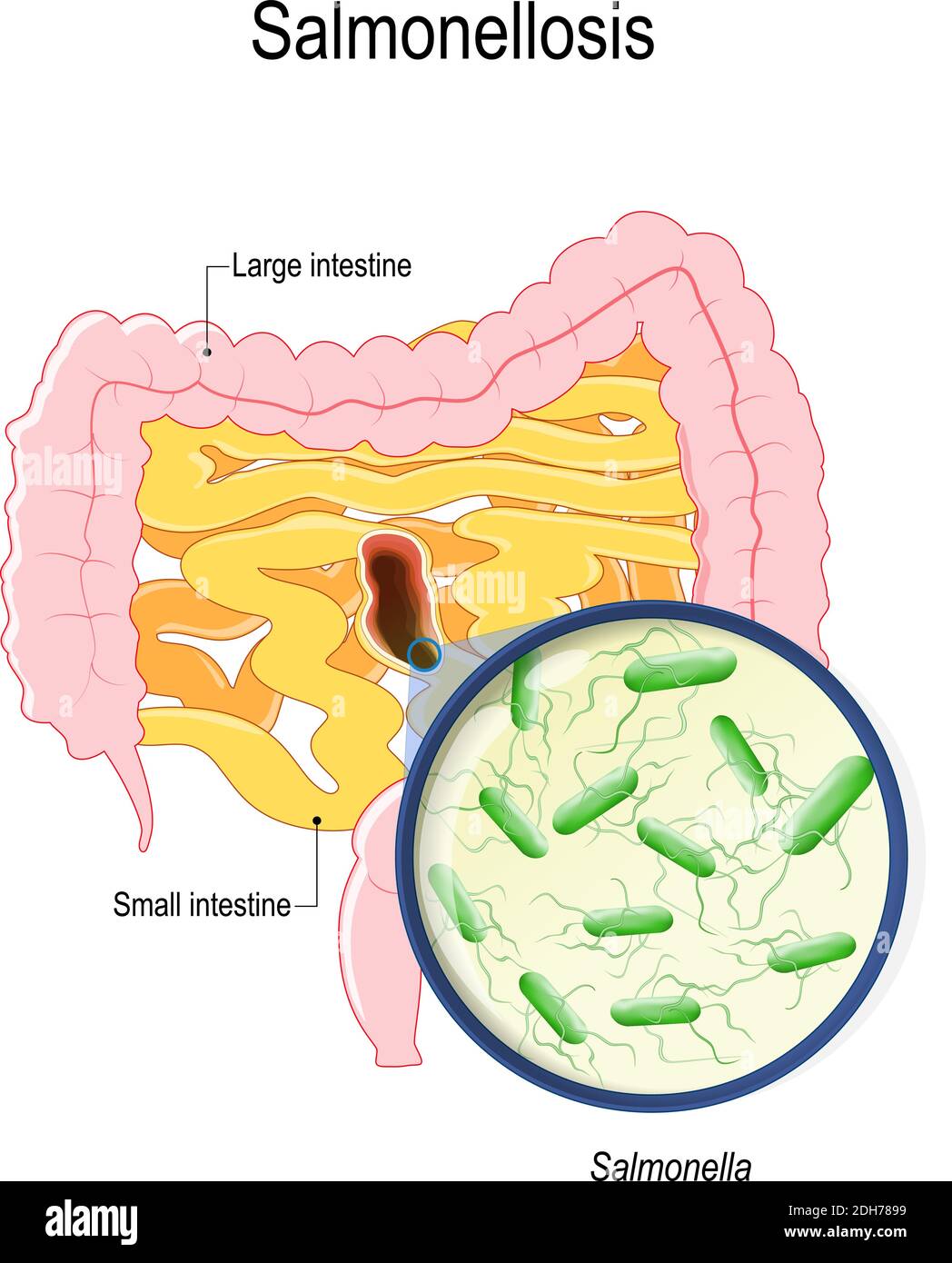 la salmonellosi è avvelenamento da salmonella da pollo crudo e uova. intestini umani e batterio che causano questa malattia Illustrazione Vettoriale