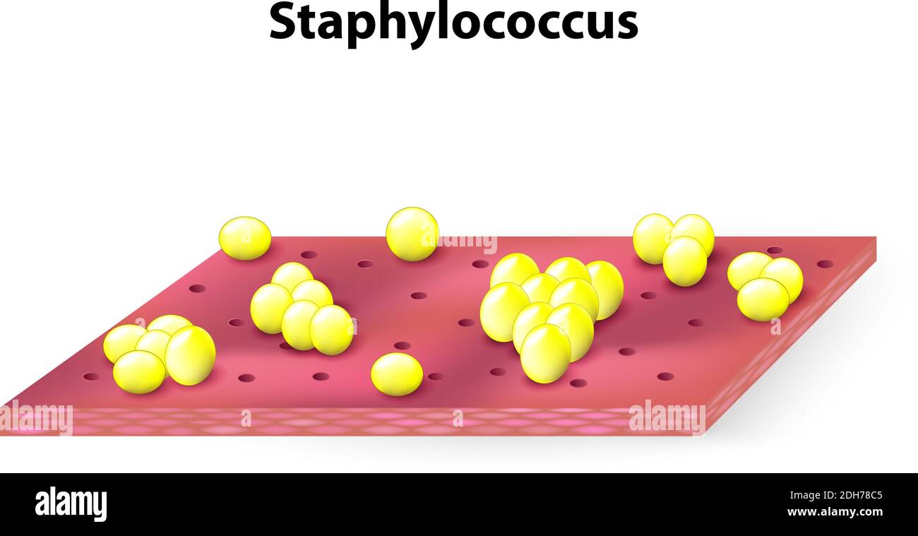 colonie di staphylococcus sulla superficie cutanea. Illustrazione vettoriale Illustrazione Vettoriale