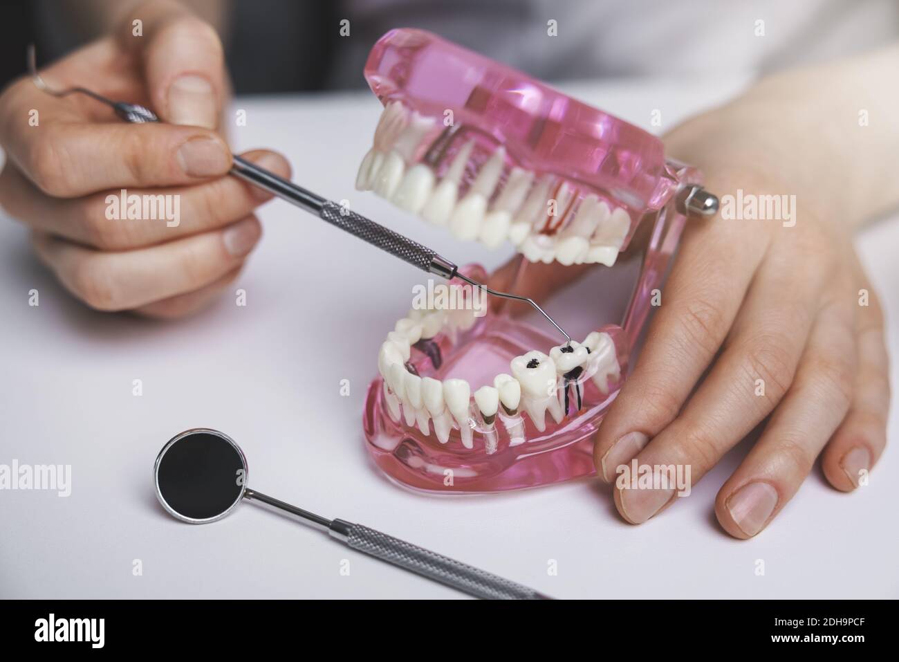 dentista che mostra carie dentali carie carie carie dentali decadono sul modello della mascella Foto Stock