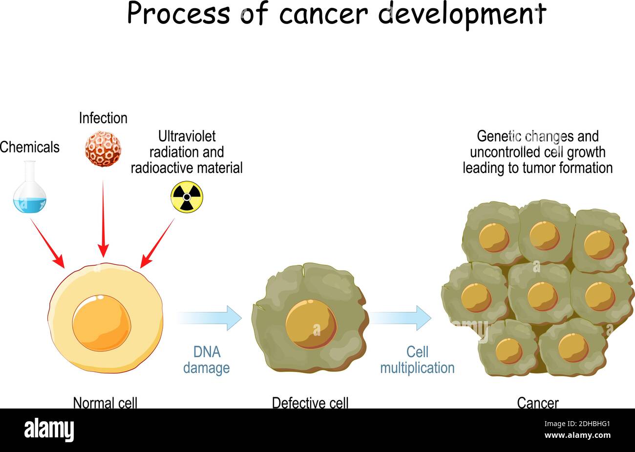 processo di sviluppo del cancro. Agenti che causano il cancro e le fasi di trasformazione della cellula normale in cellule difettose e cancro. Cambiamenti genetici Illustrazione Vettoriale