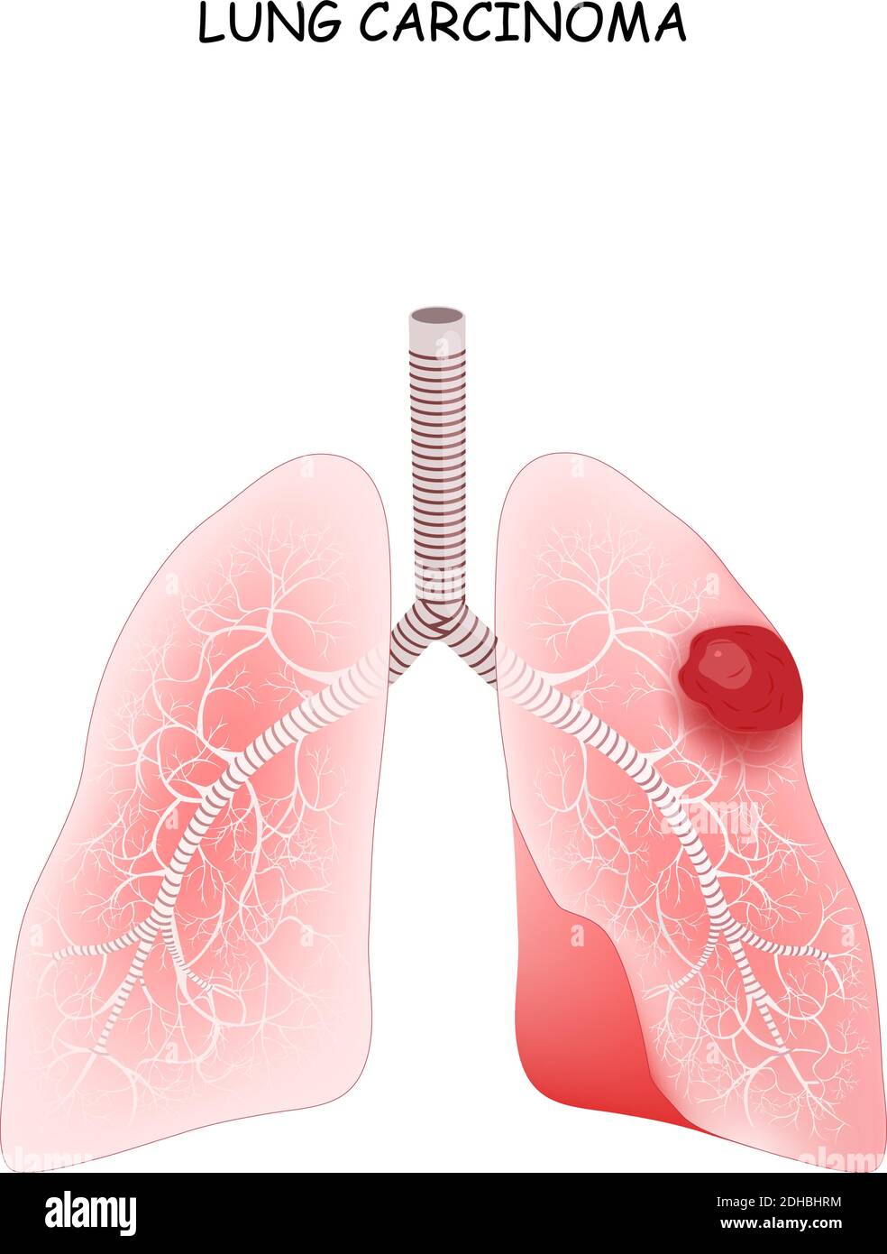 Carcinoma polmonare. Il carcinoma è un tumore maligno del polmone. Illustrazione vettoriale per uso medico Illustrazione Vettoriale