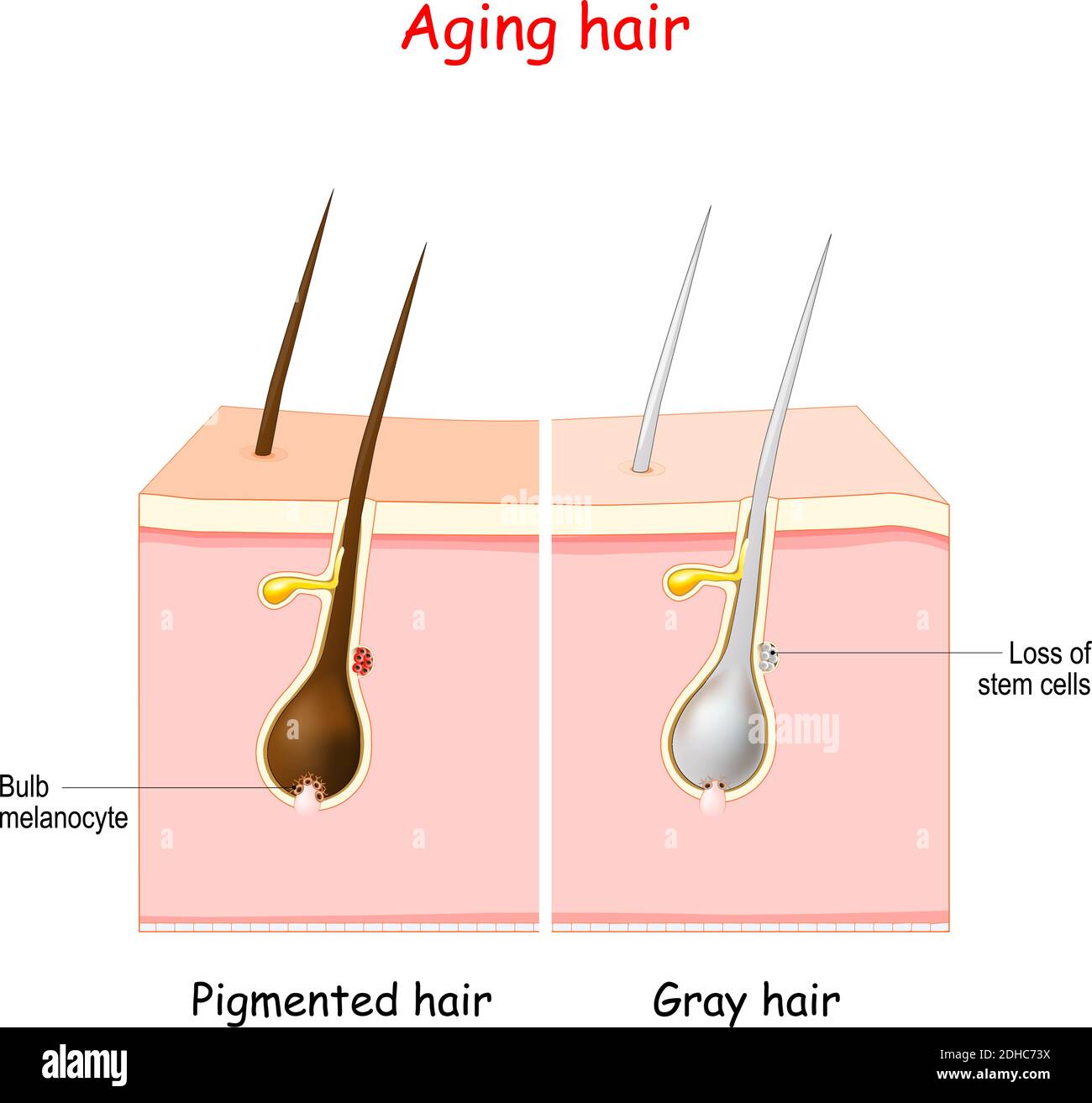 processo di invecchiamento attraverso i capelli grigi. Capelli pigmentati e grigi. Le cellule staminali ai follicoli piliferi producono melanociti, che producono e immagazzinano pigmento Illustrazione Vettoriale