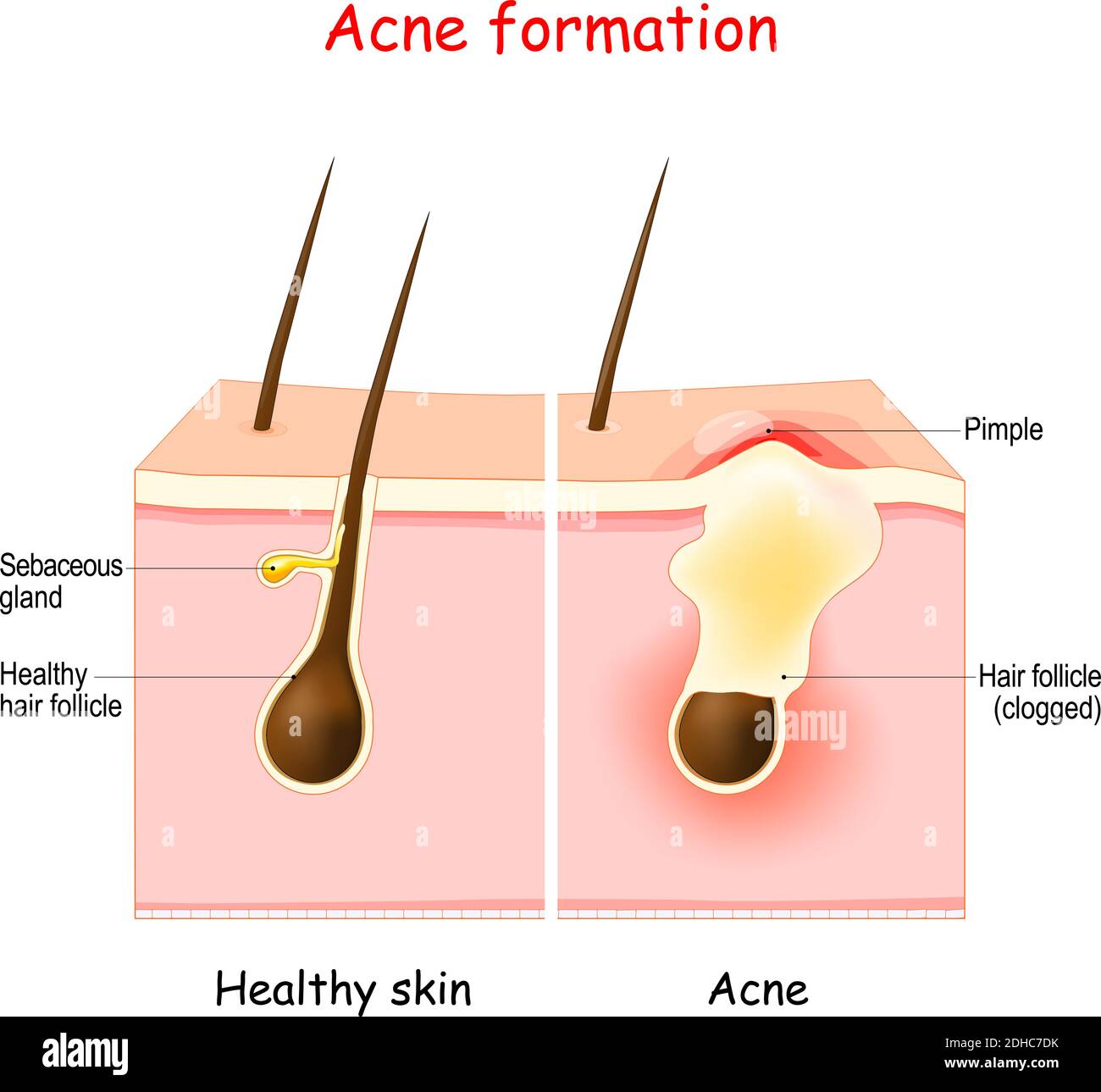 Acne. Pimple infiammato sulla pelle. Il sebo nel poro intasato promuove la  crescita di un batterio. Illustrazione vettoriale. Diagramma dermatologico  Immagine e Vettoriale - Alamy